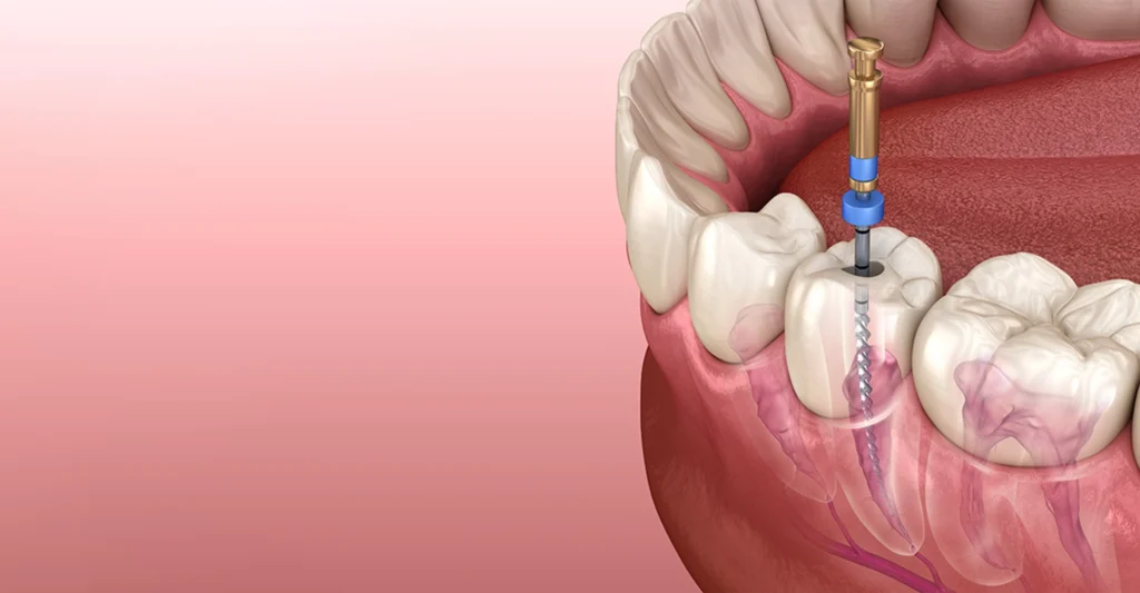 Dentist-using-dental-drill-to-perform-root-canal-treatment-on-patients-molar-1024x533 Root Canal: Procedure, Time, Risks, and Recovery Guide