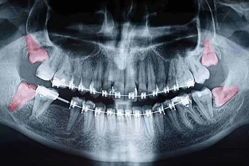 Wisdom-teeth-X-ray-before-removal How Long Does Wisdom Teeth Removal Surgery Take? (2025 Guide)